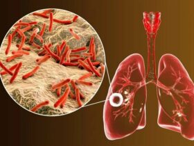 Increasing Global Threats: Tuberculosis and COVID-19 Co-infection Raises Concerns. Credit | Shutterstock
